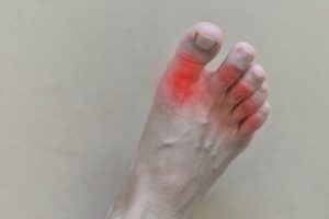 About Gout … Ouch!