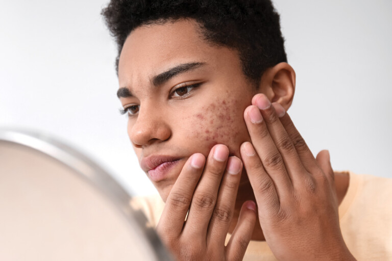 Gut Health and Acne