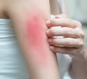 A Lactobacillus acidophilus Postbiotic for Allergy, Skin Health & Immune Health Support